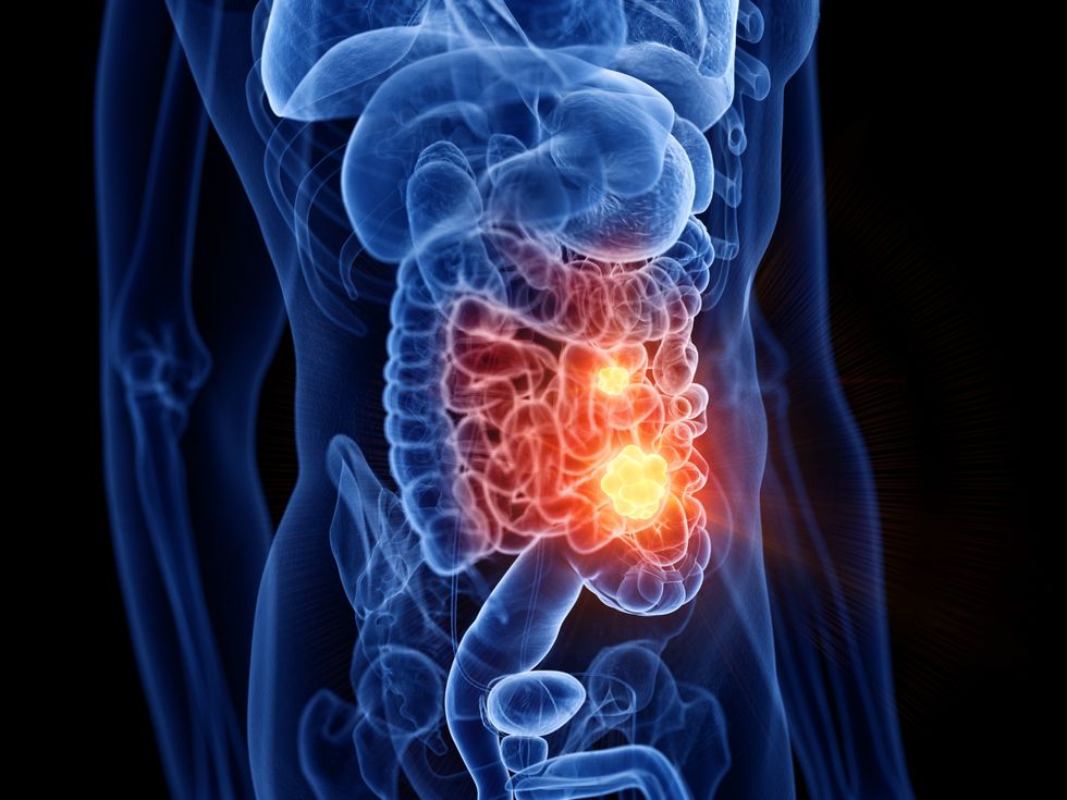 Cancer illustration body