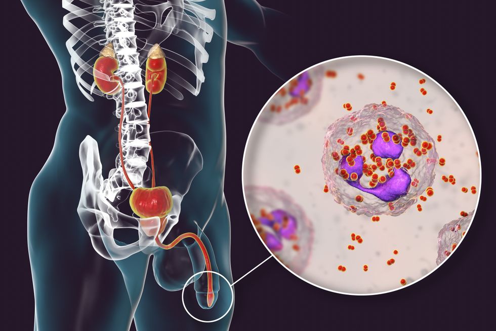GONORRHOEA COMPOSITE